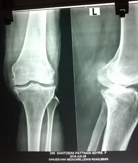 X-Ray of Santosini Pattanayak
