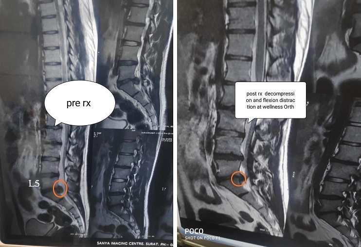 Decompression & Flexion Distraction