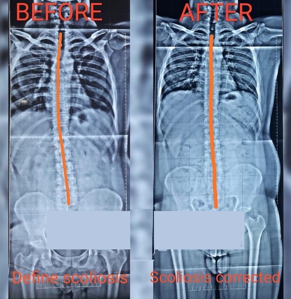 Chiropractice Treatment